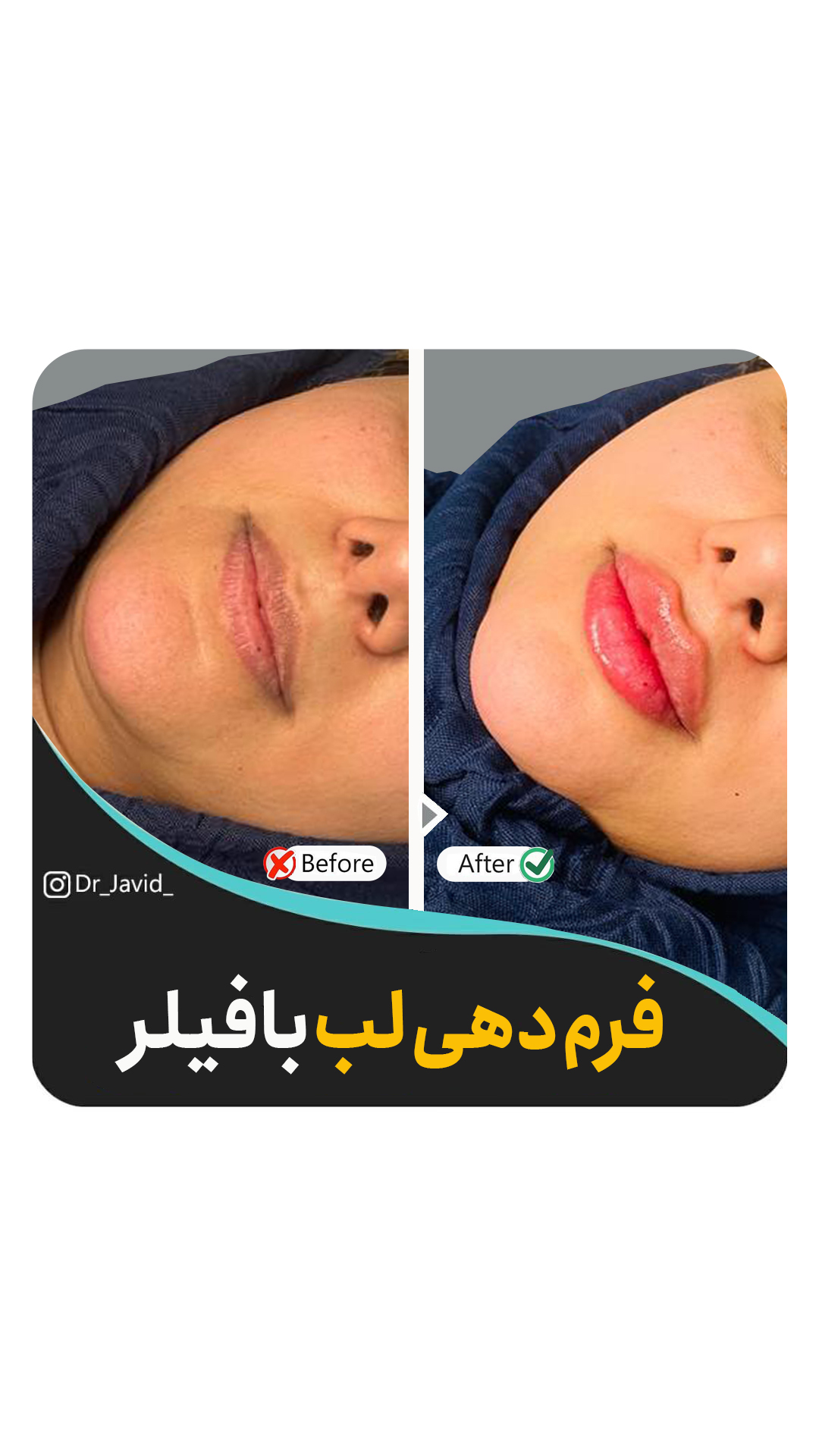 تزریق فیلر لب